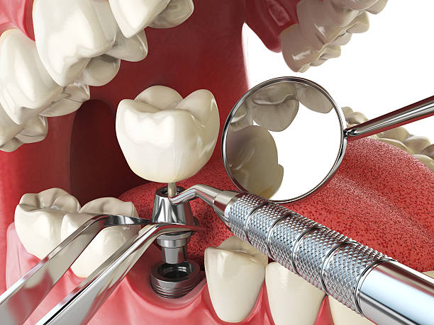 Best Emergency Dental Care for Abscessed Tooth in Ransom Canyon, TX
